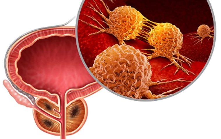 Prostate cancer